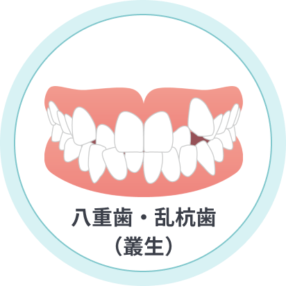 八重歯・乱杭歯(叢生)
