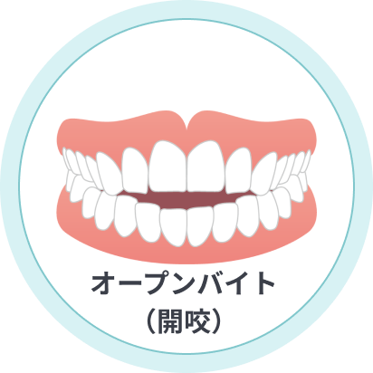 オープンバイト(開咬)