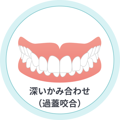 深いかみ合わせ(過蓋咬合)