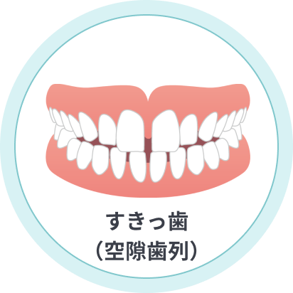 すきっ歯(空隙歯列)