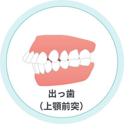 出っ歯(上顎前突)