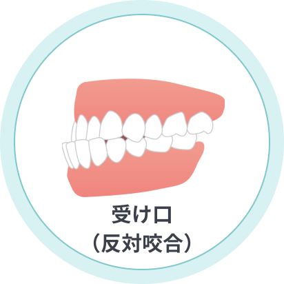 受け口(反対咬合)