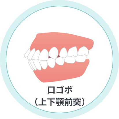 口ゴボ(上下顎前突)